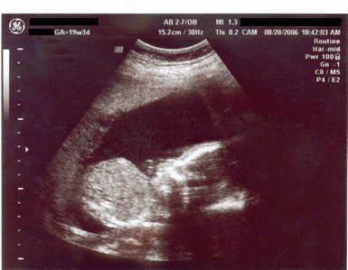 Second Ultrasound